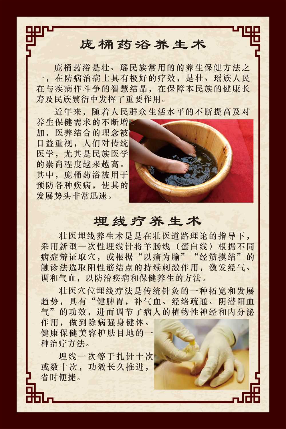 庞桶埋线